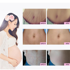Mango Antenatal Cream - RtopR Body Cream
